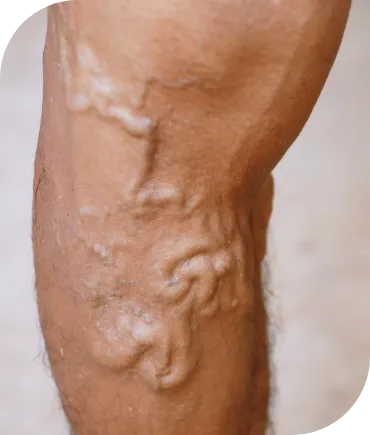 Varicose Vein