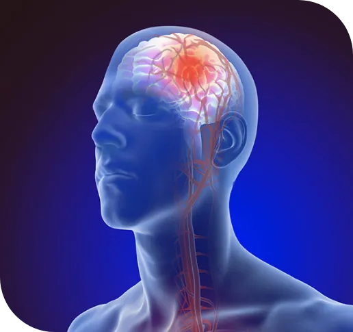 image of post stroke Ayurvedic Treatment for Stroke at Sreerudra Ayurveda