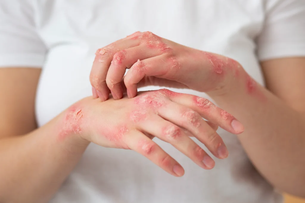 Ayurvedic Psoriasis Treatment in Kerala