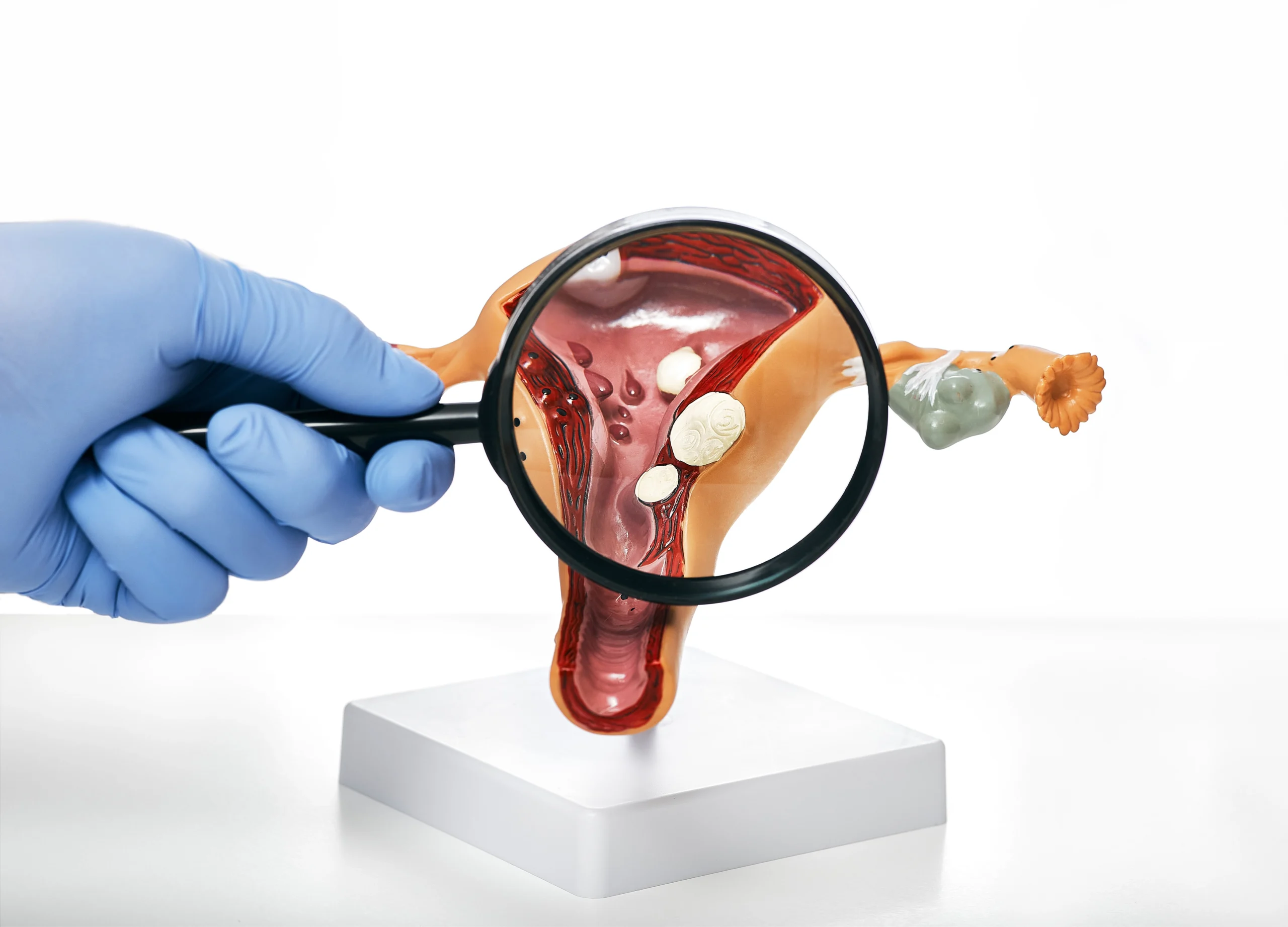 leucorrhoea treatment in ayurveda