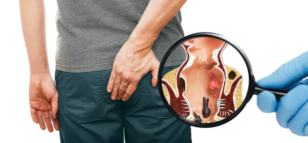 pilonidal sinus treatment