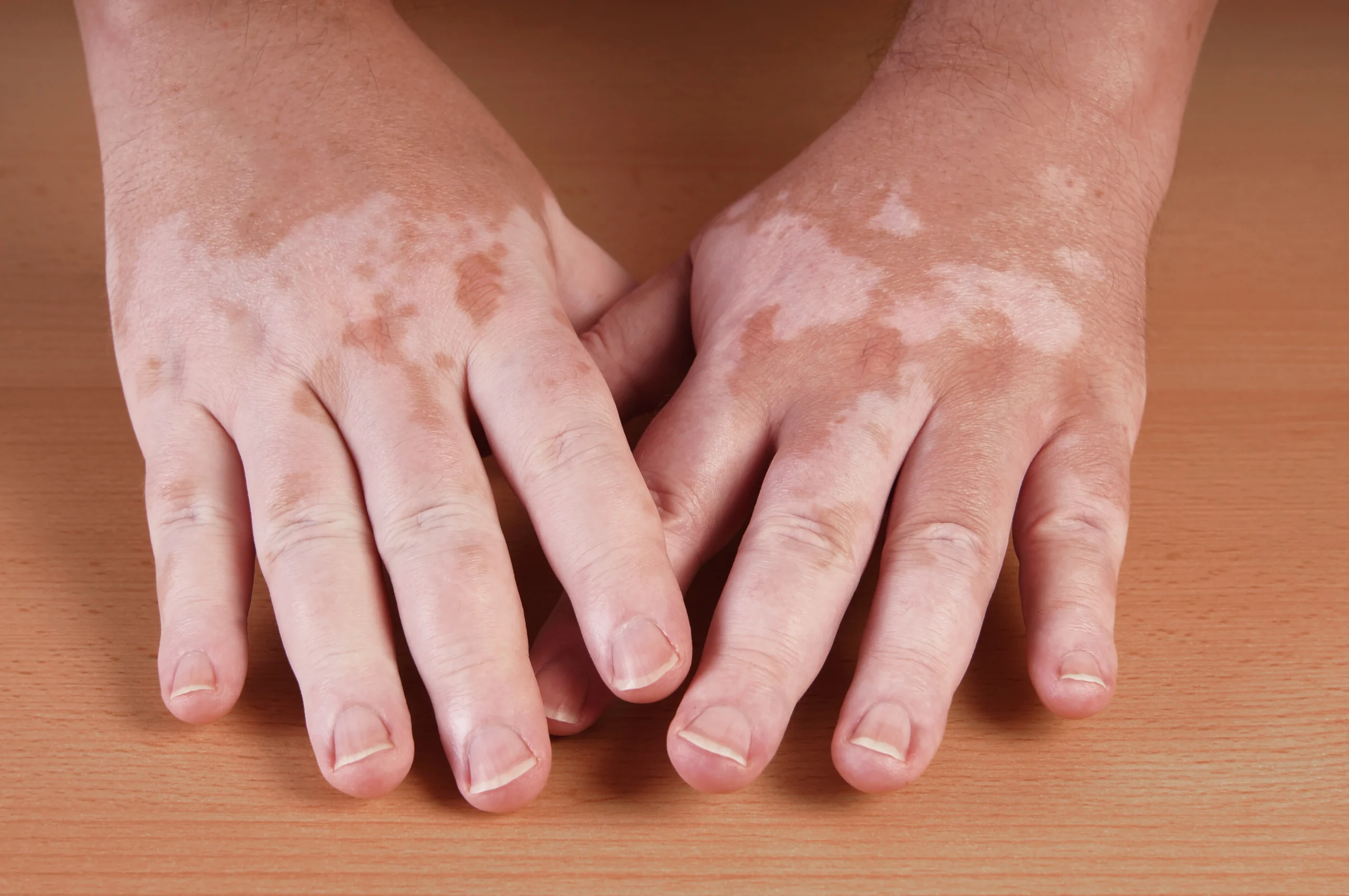 ayurvedic treatment for vitiligo